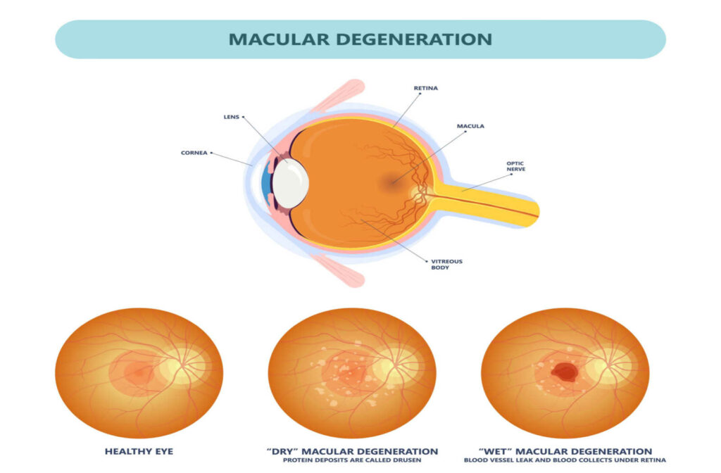 An illustration of what happens in the eye during dry and wet macular degeneration.