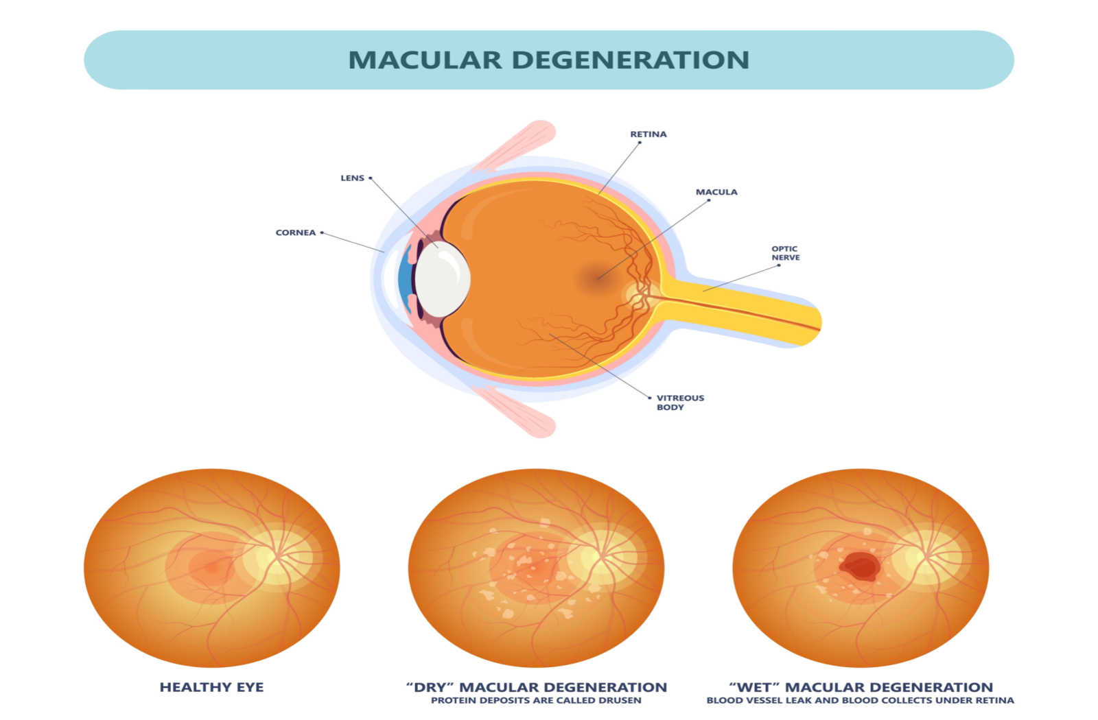 Early warning signs of macular degeneration santa monica