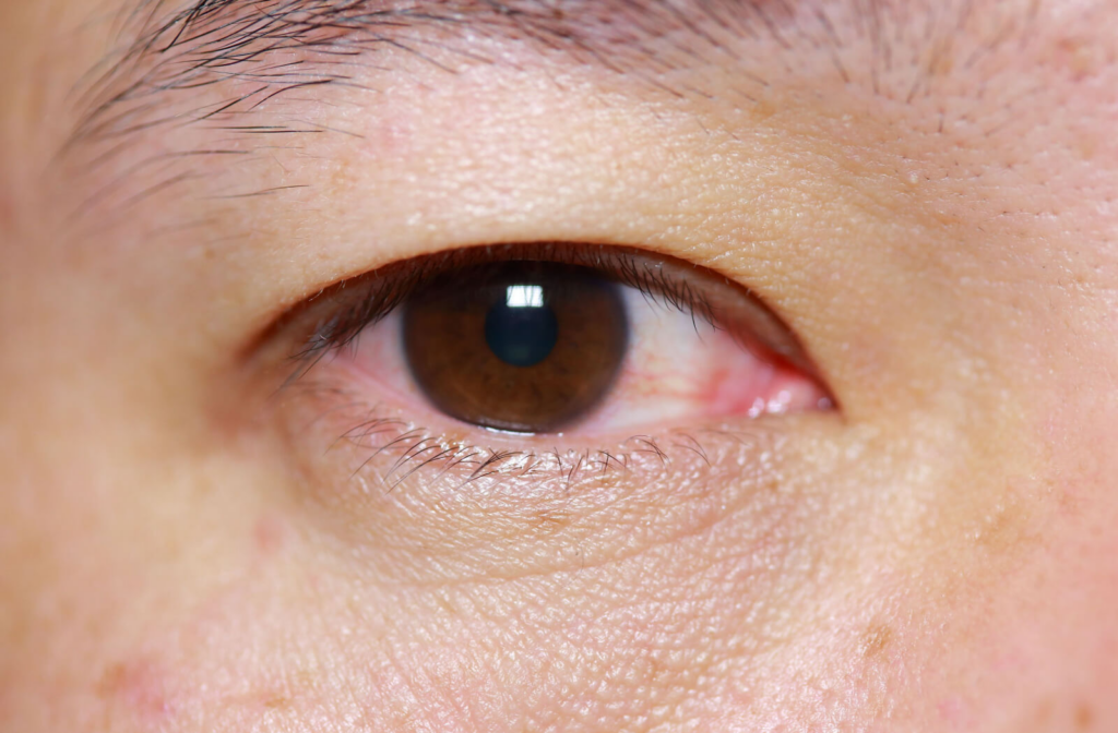 A close-up of an eye with redness around the edges.